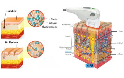 Công nghệ Hifu nâng cơ, trẻ hòa da
