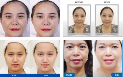 Hifu vline liftera là gì - Khám phá sự thay đổi ấn tượng của khách hàng trước và sau liệu trình nâng cơ Hifu Vline Liftera